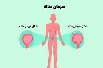 دیبنزولیوم آپوپتوز را القا می کند و انتقال اپیتلیال - مزانشیمی (EMT) را در رده های سلولی سرطان مثانه مهار می کند.